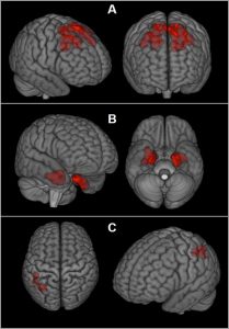 Football_Concussions_Brain_Scans_06873
