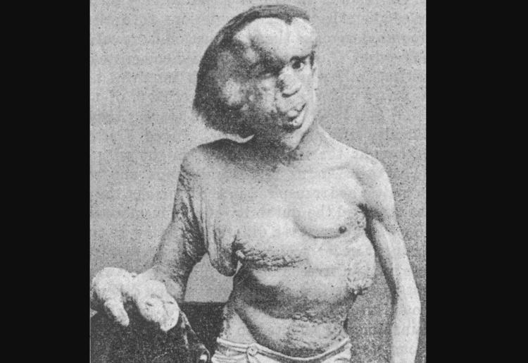 A photo of Joseph Merrick, often referred to as the "Elephant Man," taken in 1889. This photo was originally published in the British Medical Journal, Vol. 1, No. 1529 (April 19, 1890). 