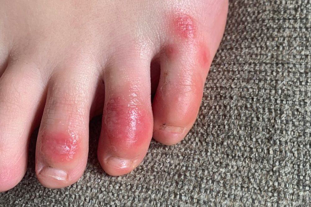 Virus_Outbreak_Skin_Symptoms_COVID_Toes_17171