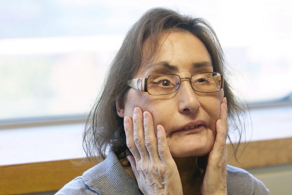 Obit_Connie_Culp_Face_Transplant_34015